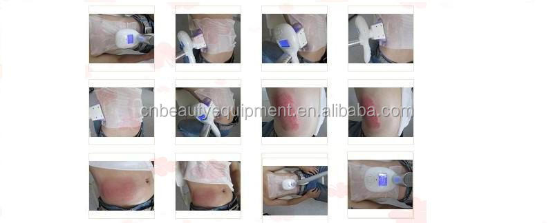 最新の技術cryolipolysis脂肪冷凍不凍剤で膜( cr- 88)問屋・仕入れ・卸・卸売り