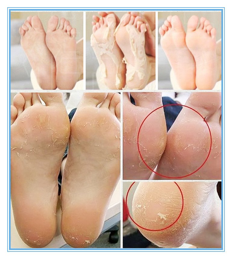 200pcs-moisture-spa-Callus-Bamboo-Vinegar-peeling-renewal-remove-dead-skin-Cuticles-Heel-smooth-exfoliating-foot