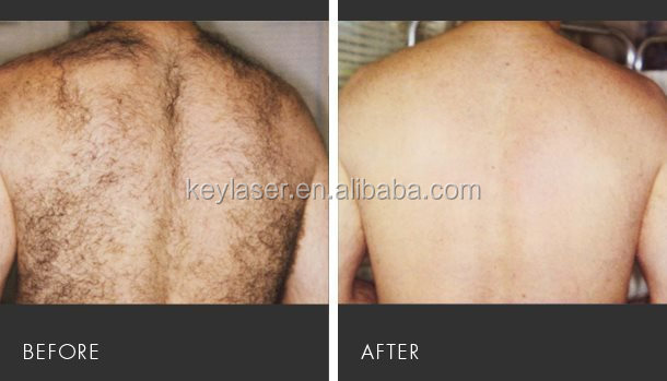 hair-removal_ba_2