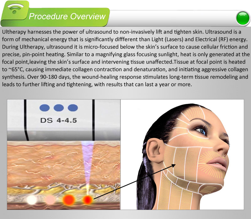 プロの2015ultherapyマシンの販売、 集束超音波hifu高強度、 33侵入深さのヒント必要な販売代理店問屋・仕入れ・卸・卸売り
