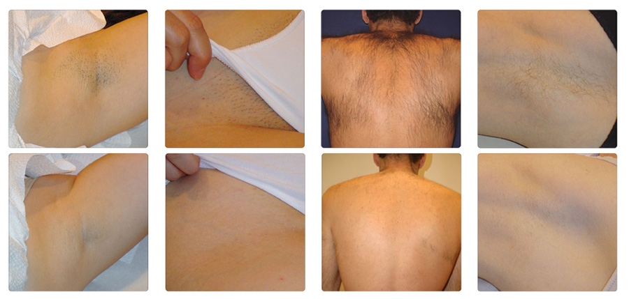 Painless Laser Hair Removal Treatment For Men And Women Remove