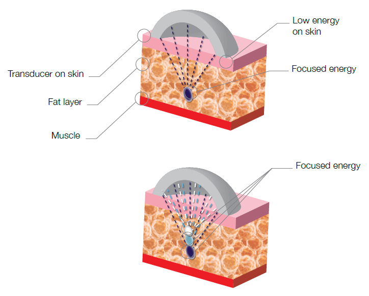 Portable HIFU Machine!!! Face TignteningVaginal Tightening HIFU Machine for Salon Use (2).png