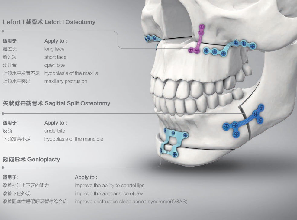 Maxillofacial Orthognathic titanium Micro Mini plates Surgical fracture screws and plates, View