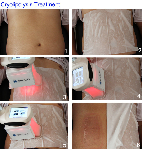 超形状痩身システムlipocryo凍結クールな形状痩身システム問屋・仕入れ・卸・卸売り