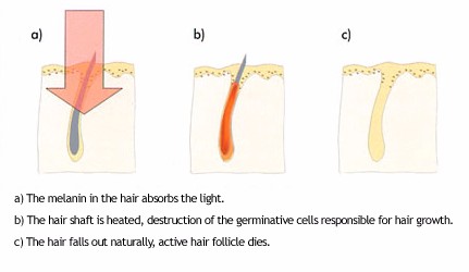 Factory outlet Best Permanent hair removal shr ipl fda laser machine.jpg
