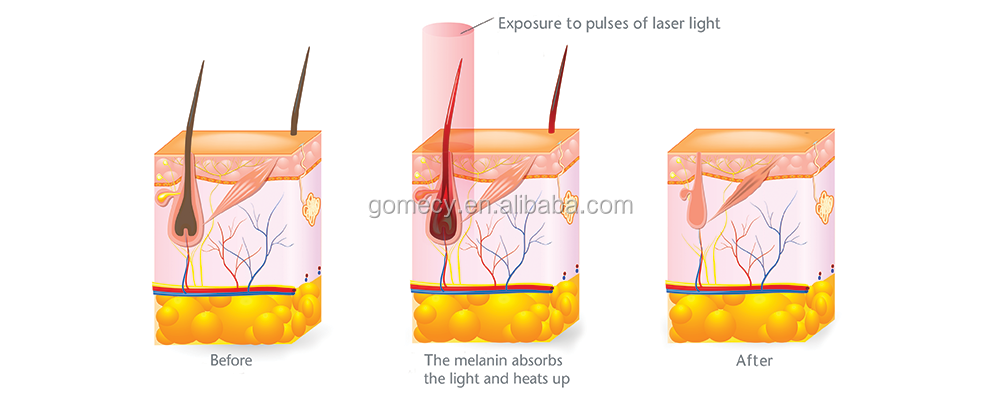 ipl shr working SHR hair remove skin rejuvenaiton e-light pulse light hair removal.png
